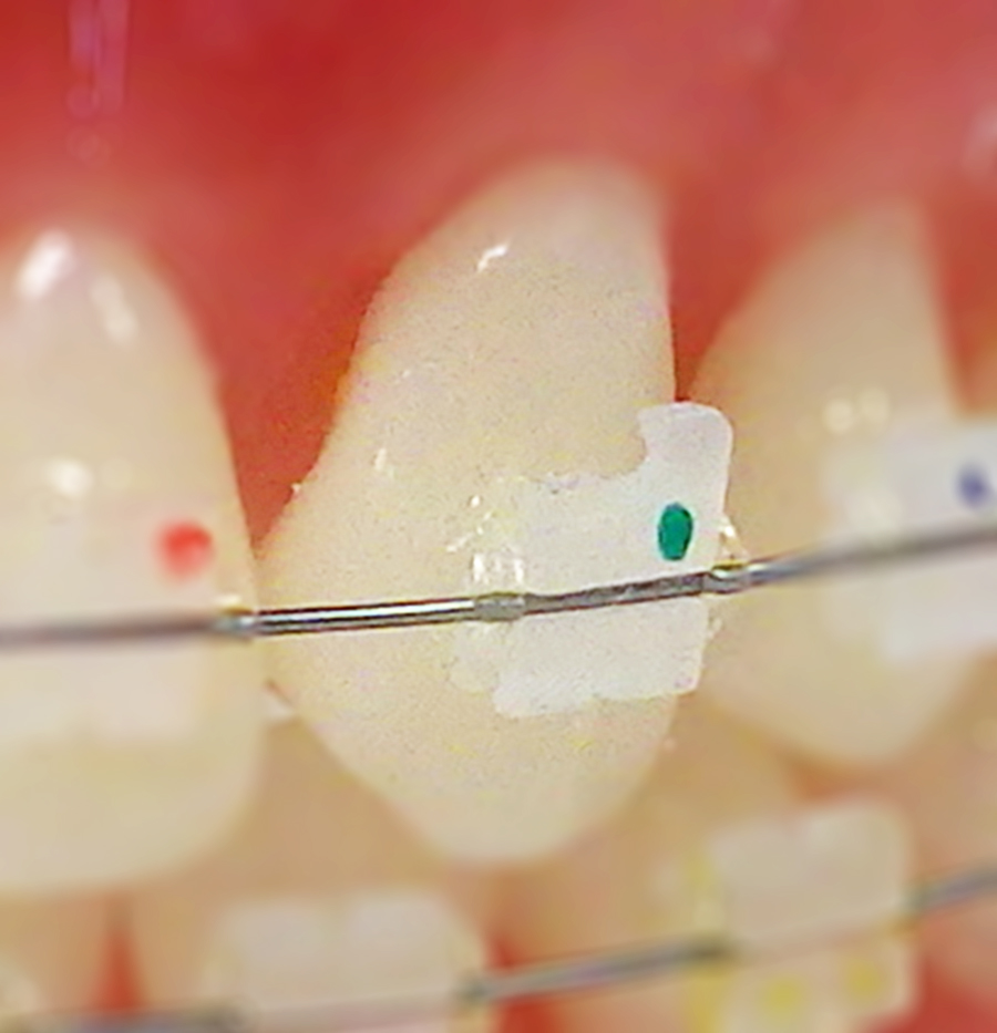 Accent™ Ceramic Brackets, Roth, .022 (1 ct) Young Specialties