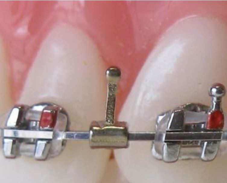 Ortho Specialties Gold Tone Hooks, Regular 6mm (20 ct) Young Specialties