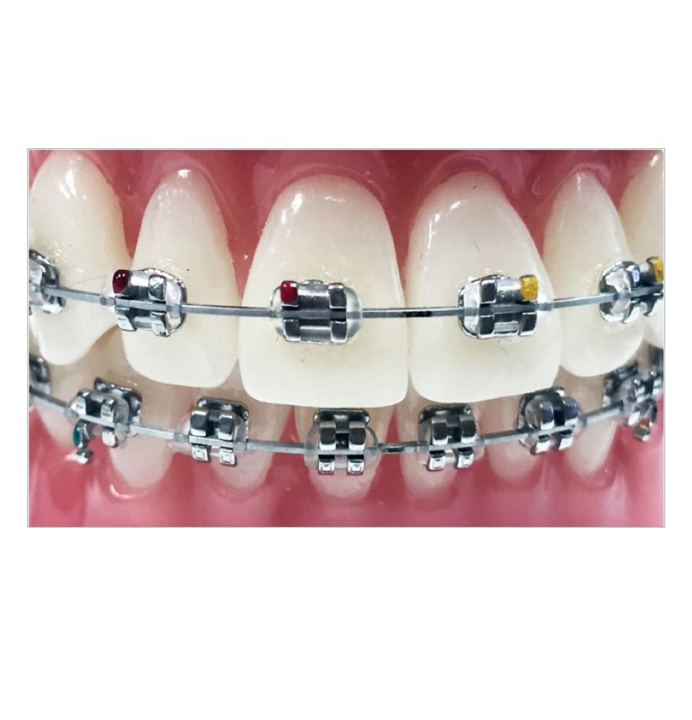Traditional Slim Stainless Steel Bracket, MBT, .022 (1 ct) Young Specialties