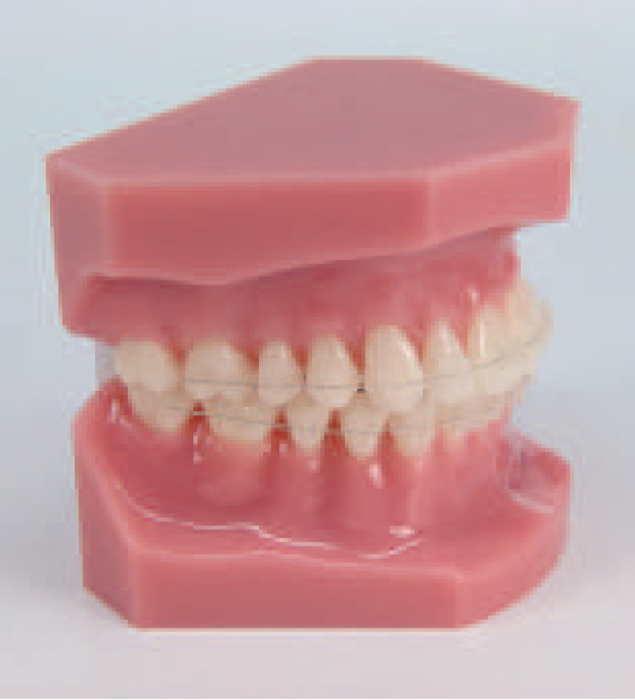 Avair Aesthetic Bracket, Roth, .022 (1 ct) Young Specialties