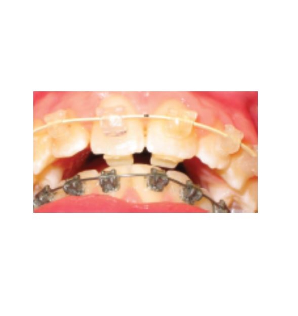 Bite Bumper™ (10 ct) Young Specialties