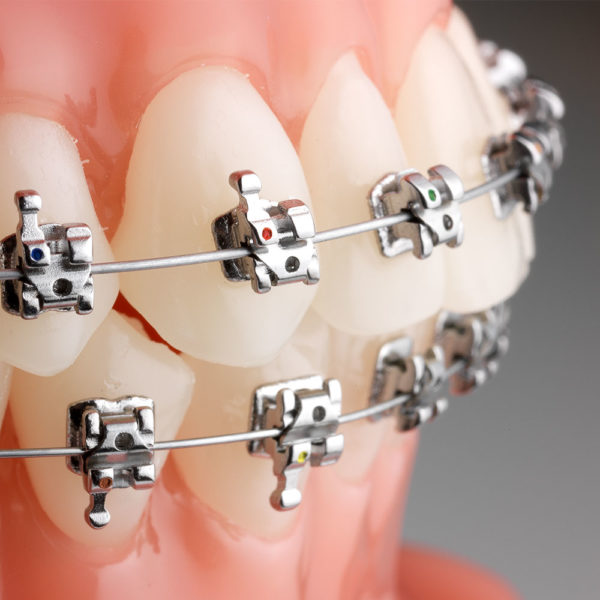 Braces Bracket Hooks At Joseph Stanfield Blog