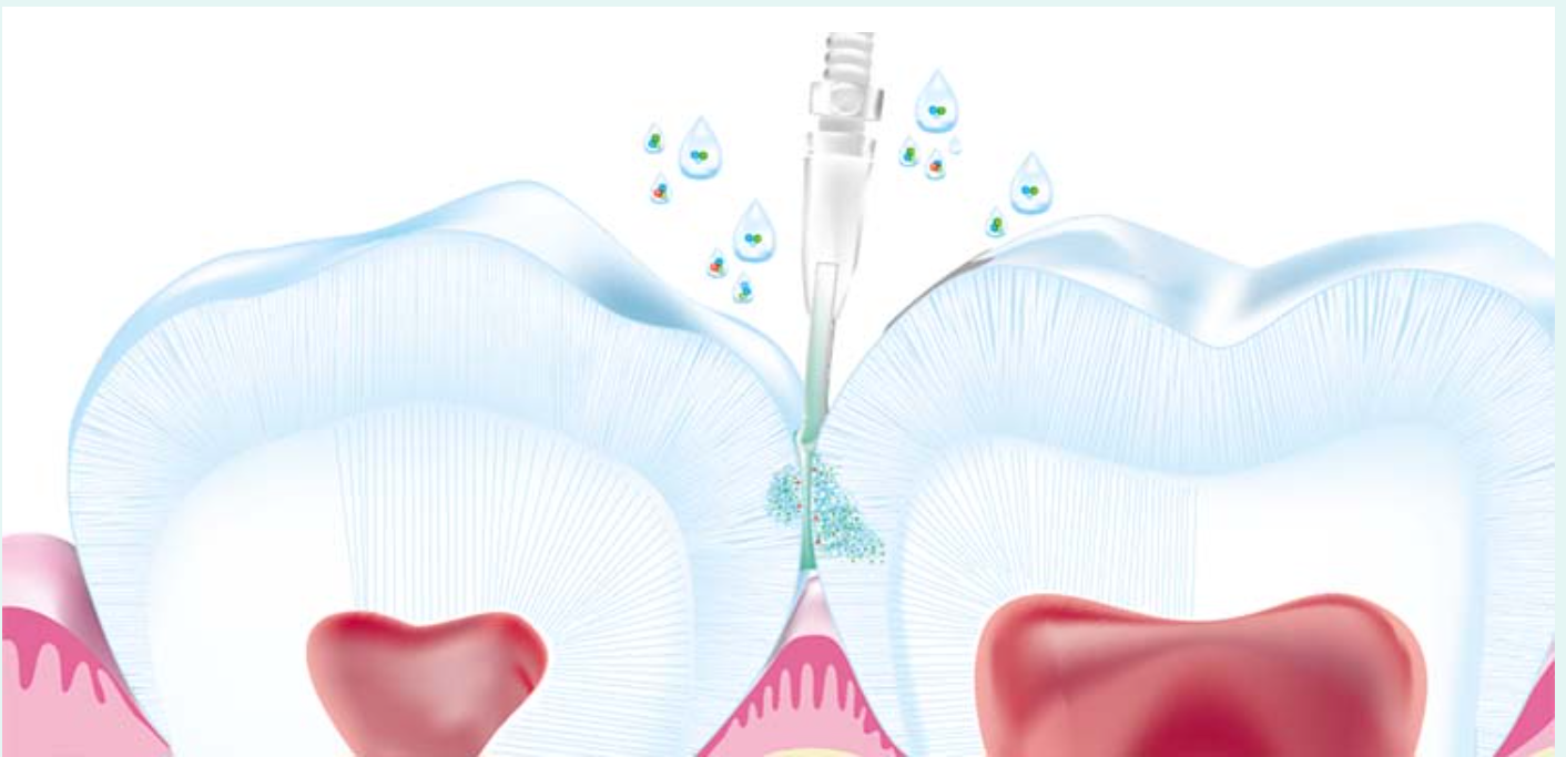 Curodont Repair Fluoride Plus Re mineralize White Spot Lesions