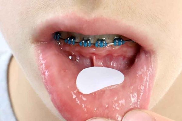 Mouth Aid 2