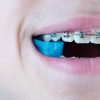 Ortho Chewz1