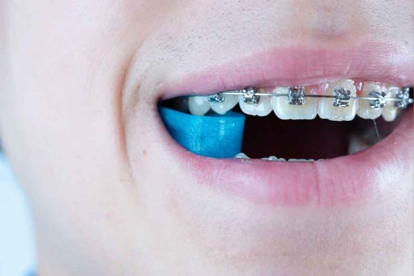 Ortho Chewz1